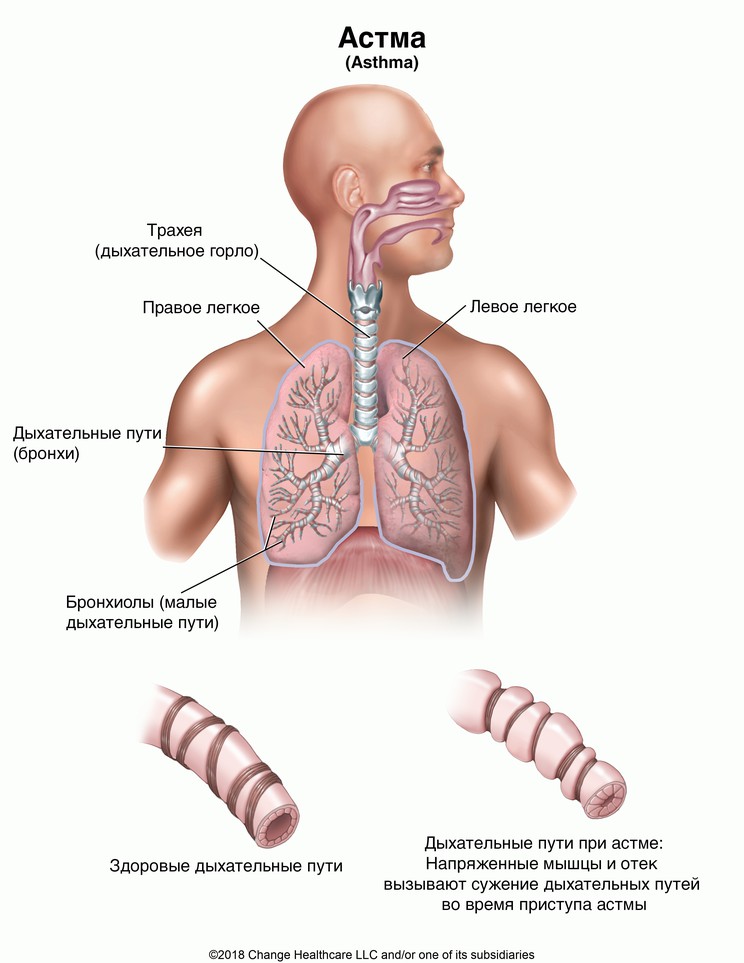 Asthma: Illustration