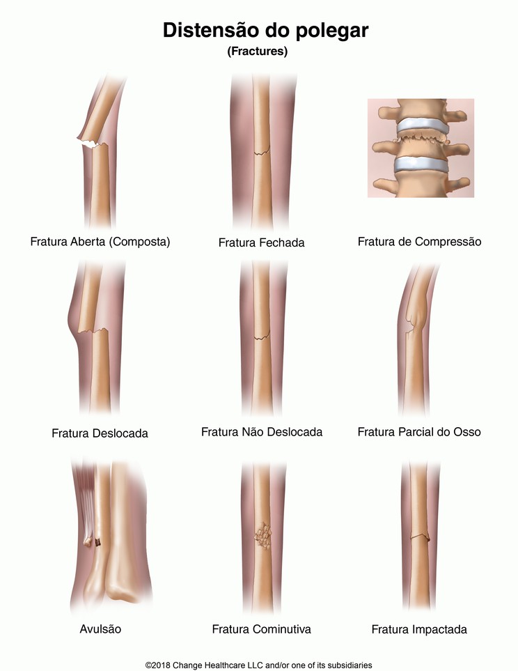 Fractures: Illustration