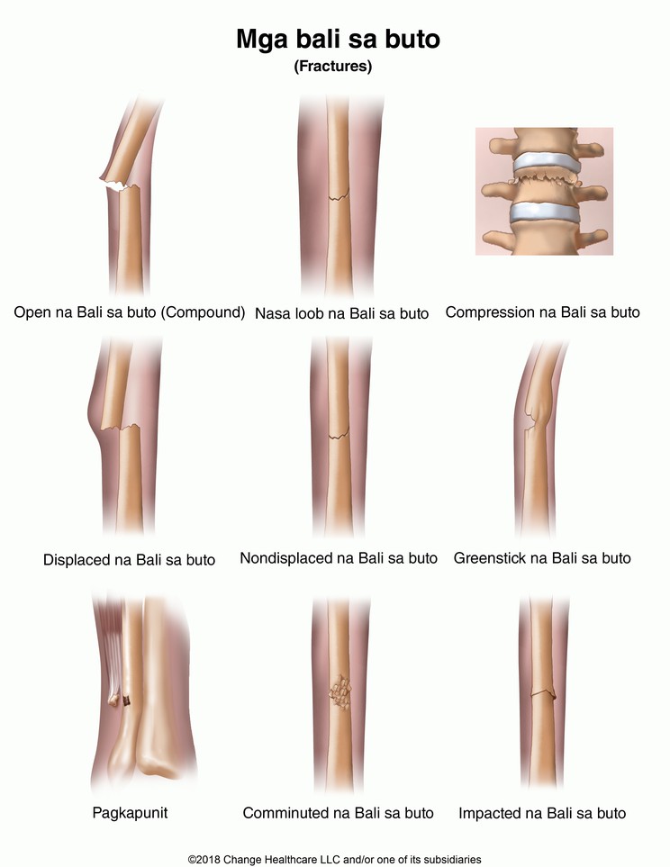 Fractures: Illustration