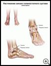 Thumbnail image of: Ankle Sprain: Illustration