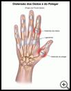 Thumbnail image of: Finger and Thumb Sprain: Illustration