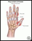 Thumbnail image of: Finger and Thumb Sprain: Illustration